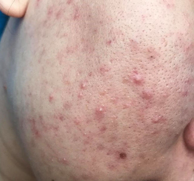 Bộ 3 sản phẩm trị mụn nhanh chóng OBAGI CLENZIDERM
