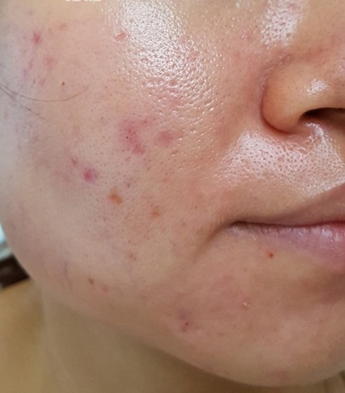 Acnilogic Cream Serum - Serum điều chỉnh sự tiết nhờn