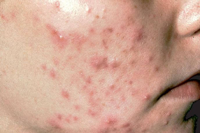 Intense Regulating Concentrate - Tinh chất điều tiết lượng nhờn, se khít lỗ chân lông